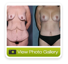body-lift-san-diego