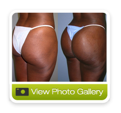 Butt And Thigh Lift 50