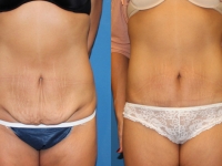 tummy-tuck-before-after San Diego Tummy Tuck