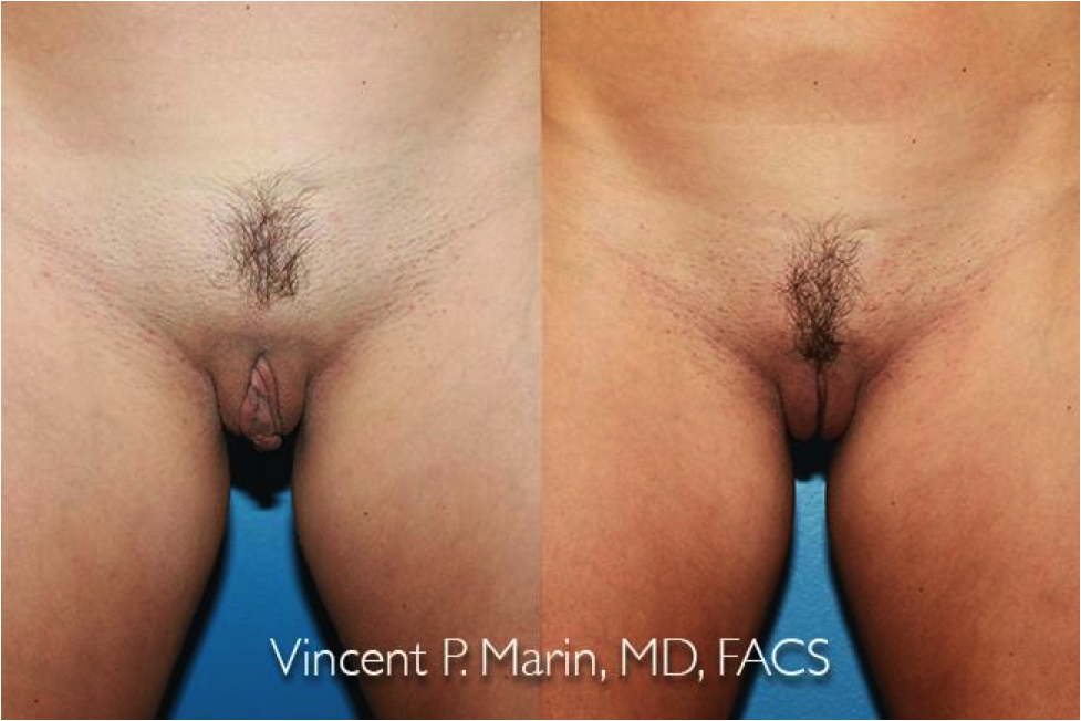 Vaginas Before And After Intercourse