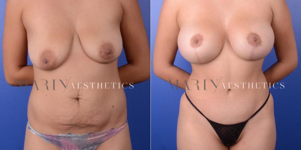 Before and After Photo