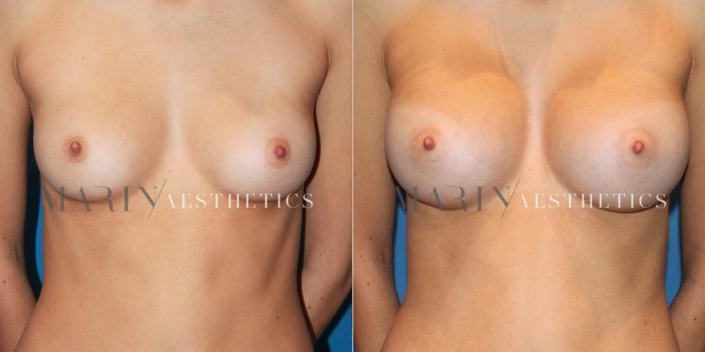 Before and After Photo