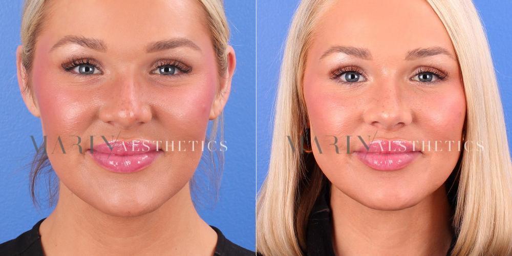 Before and After Photo