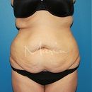 A front view before photo of Massive Weight Loss procedure at Marin Aesthetics in La Jolla San Diego California