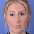 A front view after photo of Rhinoplasty procedure at Marin Aesthetics in La Jolla San Diego California