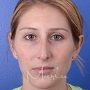 A front view before photo of Rhinoplasty procedure at Marin Aesthetics in La Jolla San Diego California