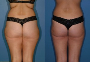 before and after liposuction