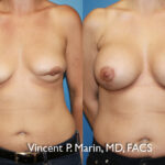 breast augmentation revision