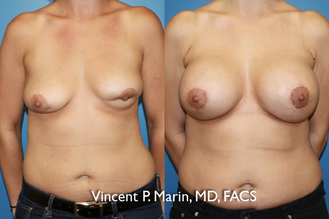 Breast Augmentation Revision Patient