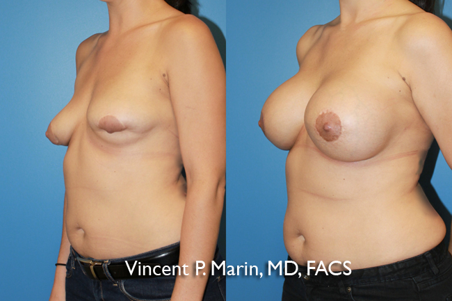 san-diego-breast-augmentation-revision
