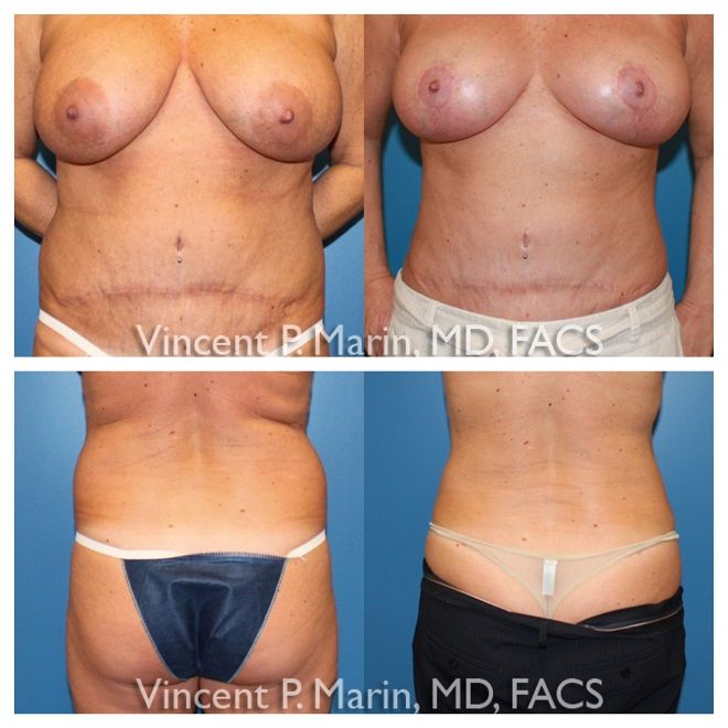 liposuction patient before and after photo