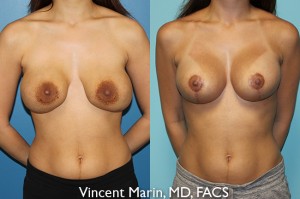 san diego breast revision