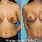 san diego breast revision featured