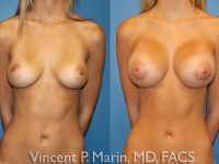 425 cc breast implants