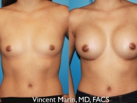 371 cc silicone gel breast implants
