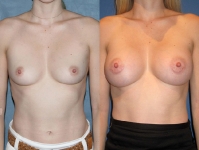 400 cc silicone gel breast implants
