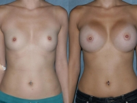 350 cc silicone gel breast implants