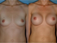 500 cc silicone gel breast implants