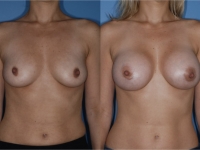 330 cc silicone gel breast implants