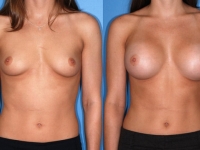 450 cc silicone gel breast implants