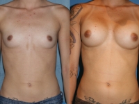 325 cc silicone gel breast implants