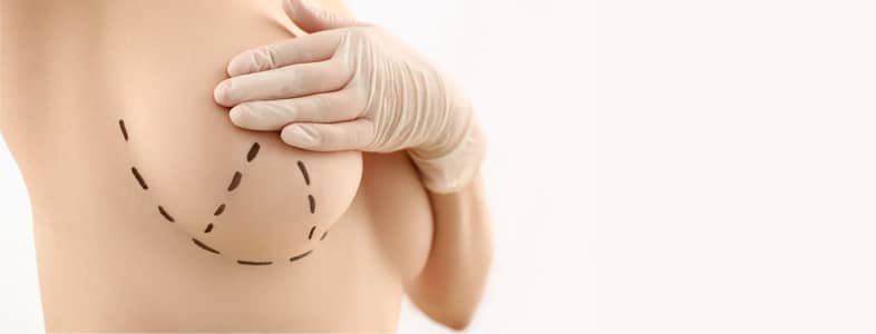 breast augmentation and areola reduction