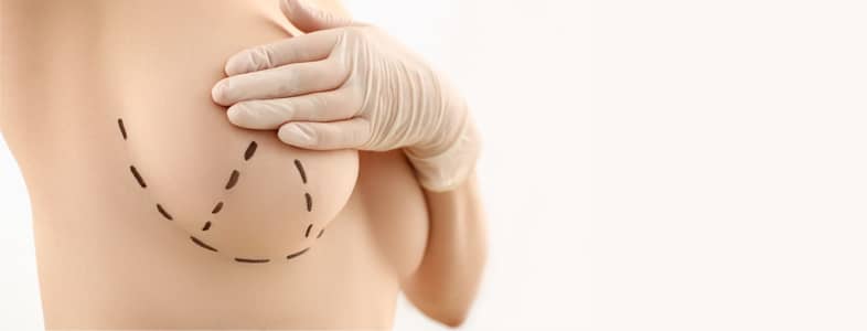breast augmentation and areola reduction