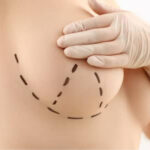 breast augmentation areola reduction featured