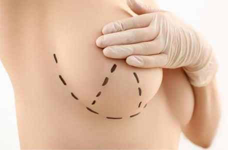 Breast Augmentation & Areola Reduction - Dr. Vincent Marin - Marin