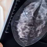 breast implants mammograms featured