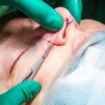 revision rhinoplasty using rib cartilage