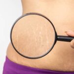 tummy tuck stretch marks