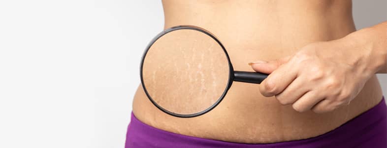 tummy tuck stretch marks