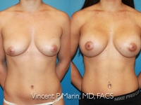 mild nipple asymmetry patient
