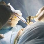 open close rhinoplasty incision