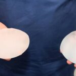 breast augmentation revision with gummy bear implants