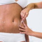 revision tummy tuck surgery