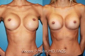 San Diego Breast Implant Revision
