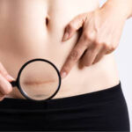 tummy tuck side effects featured