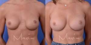Marin Aesthetics Breast Implant Revision| San Diego La Jolla Front