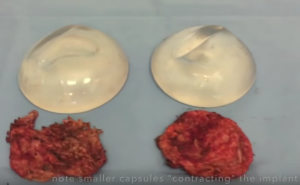 capsular contracture breast implants