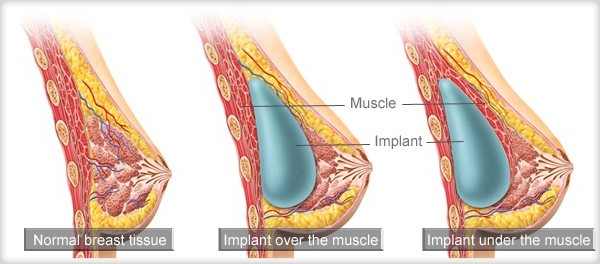 breast implant placement