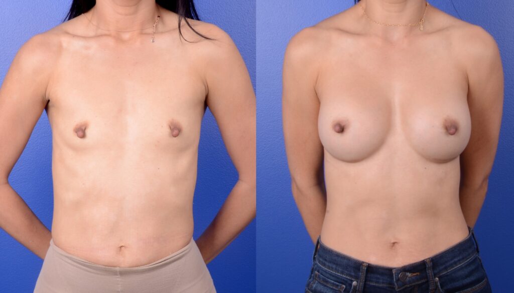 Sideboobs for women with large breasts