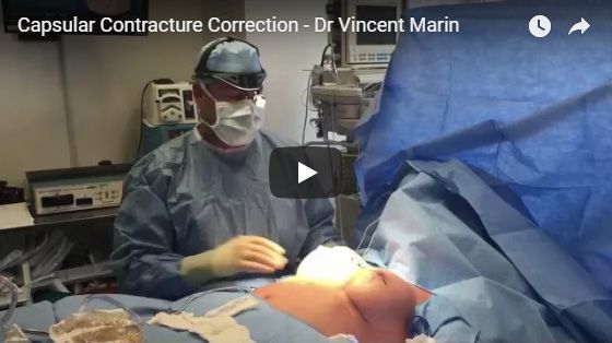 Capsular Contracture Correction - Dr Vincent Marin