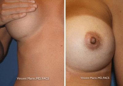 Breast Augmentation Incisions Scar