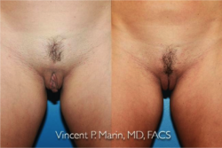labiaplasty before and after
