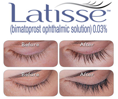 Latisse Before and After