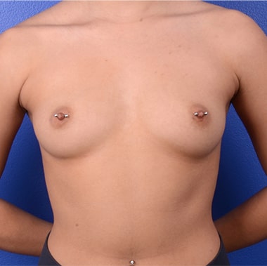 Breast Augmentation Mastopexy 1 before