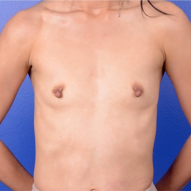 Breast Augmentation Mastopexy 2 Before