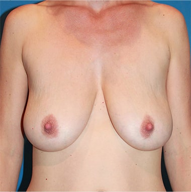 Augmentation Mastopexy And Breast Lift Front Before